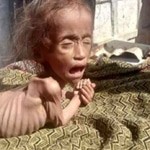 malnutrition-problem-in-nepal